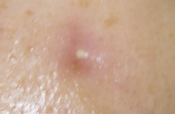 200倍浸透<VC200>大人ニキビも思春期ニキビも徹底ケア